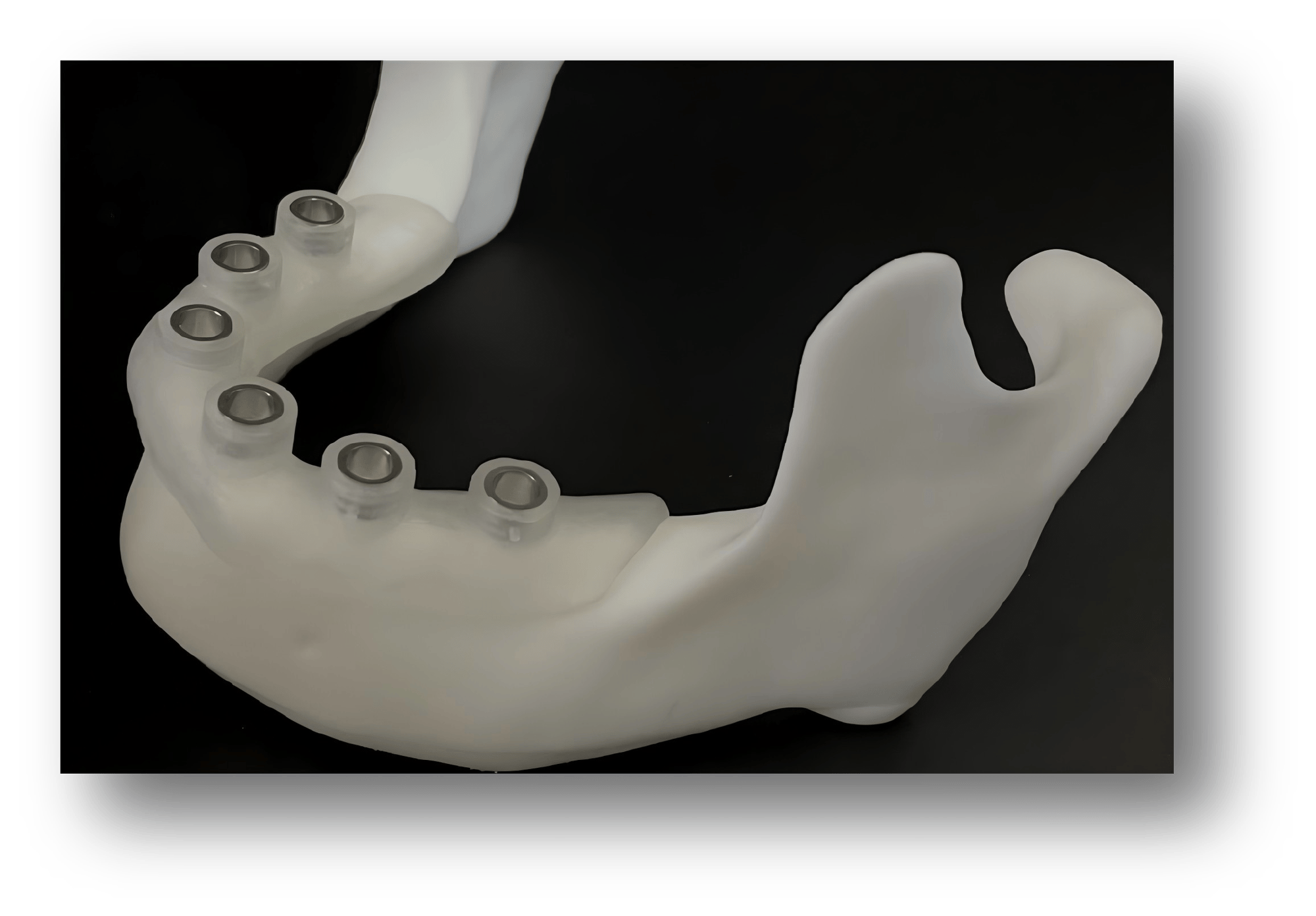 1.3D-Printed Bone-Supported Implant Surgical Guide