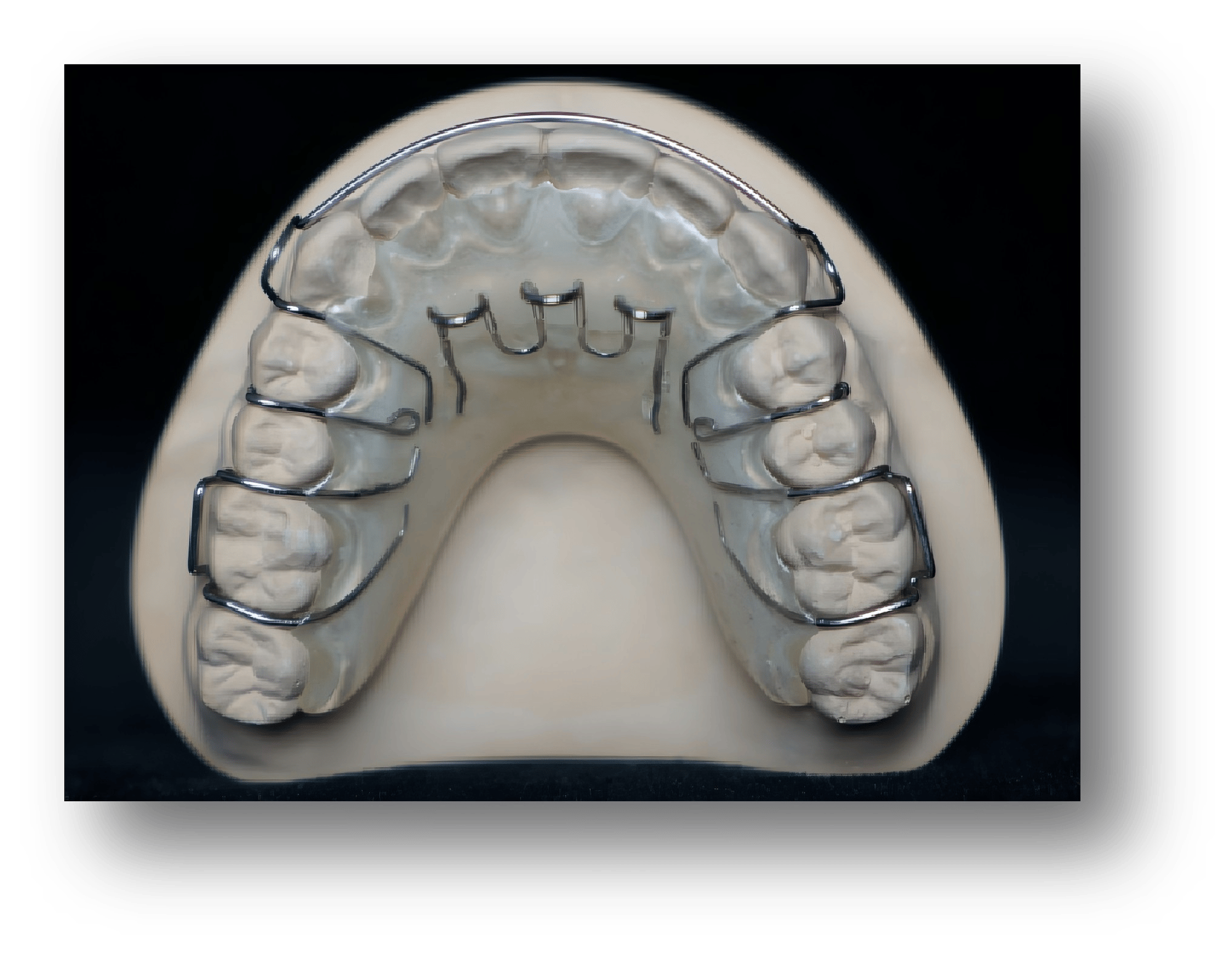 1.Removable Habit-Breaking Orthodontic Appliance 1.Removable Habit-Breaking Orthodontic Appliance