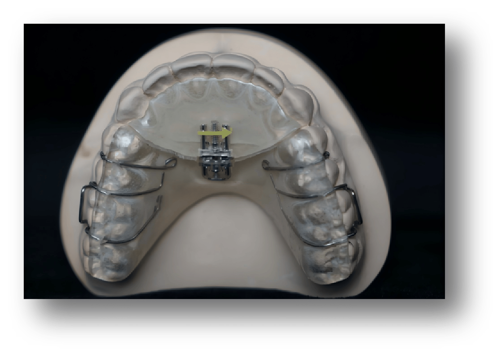 1.Removable Screw Orthodontic Appliance 1.Removable Screw Orthodontic Appliance