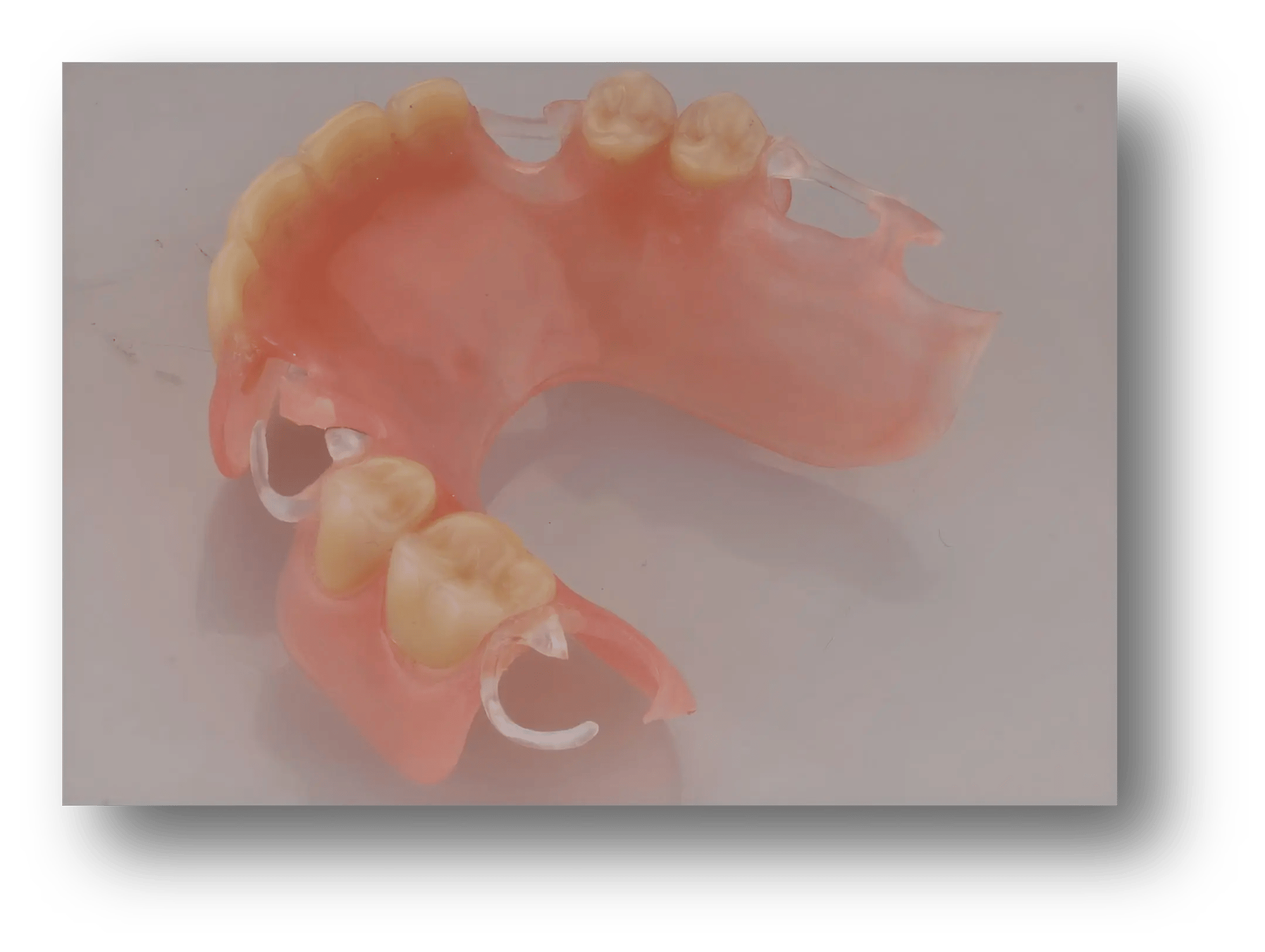 1.Resin Base Removable Partial Denture (RPD)