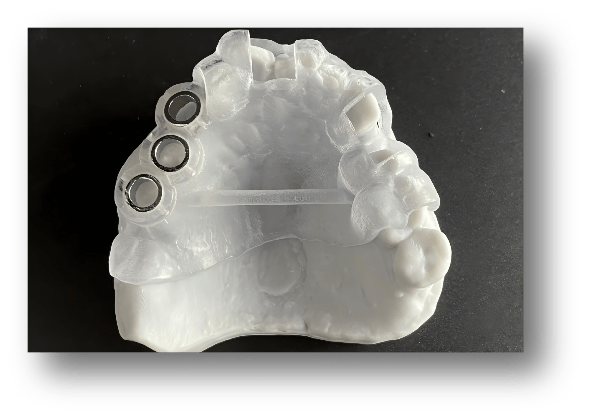 2.3D-Printed Hybrid-Supported Implant Surgical Guide