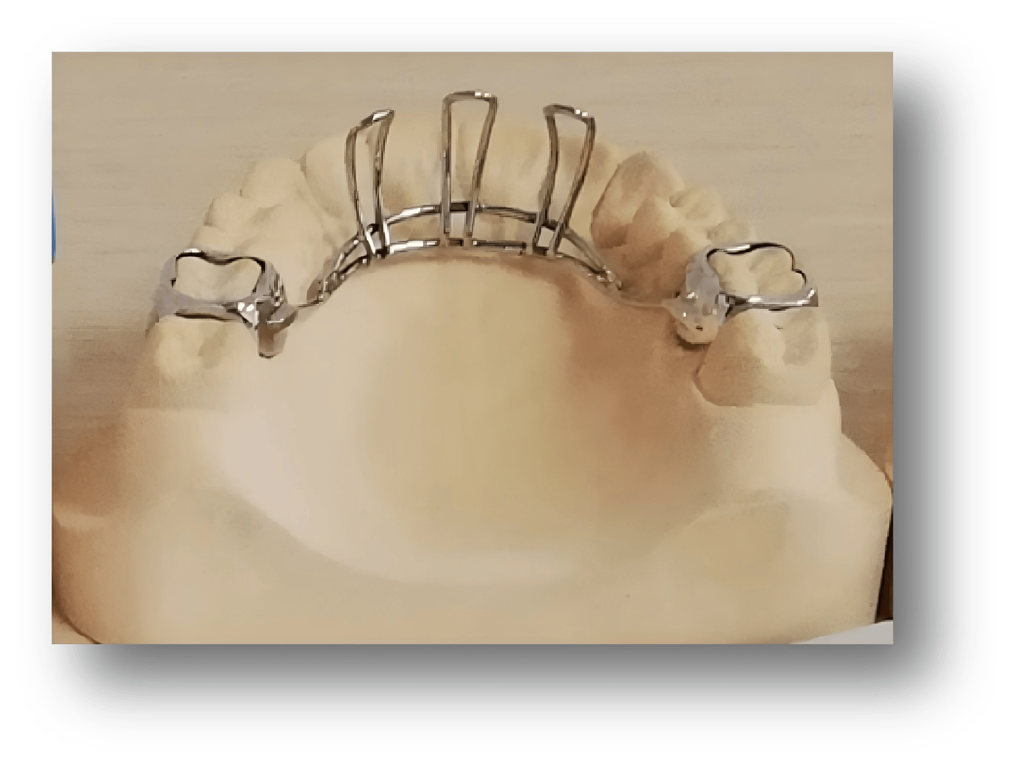 2.Fixed Habit-Breaking Orthodontic Appliance 2.Fixed Habit-Breaking Orthodontic Appliance