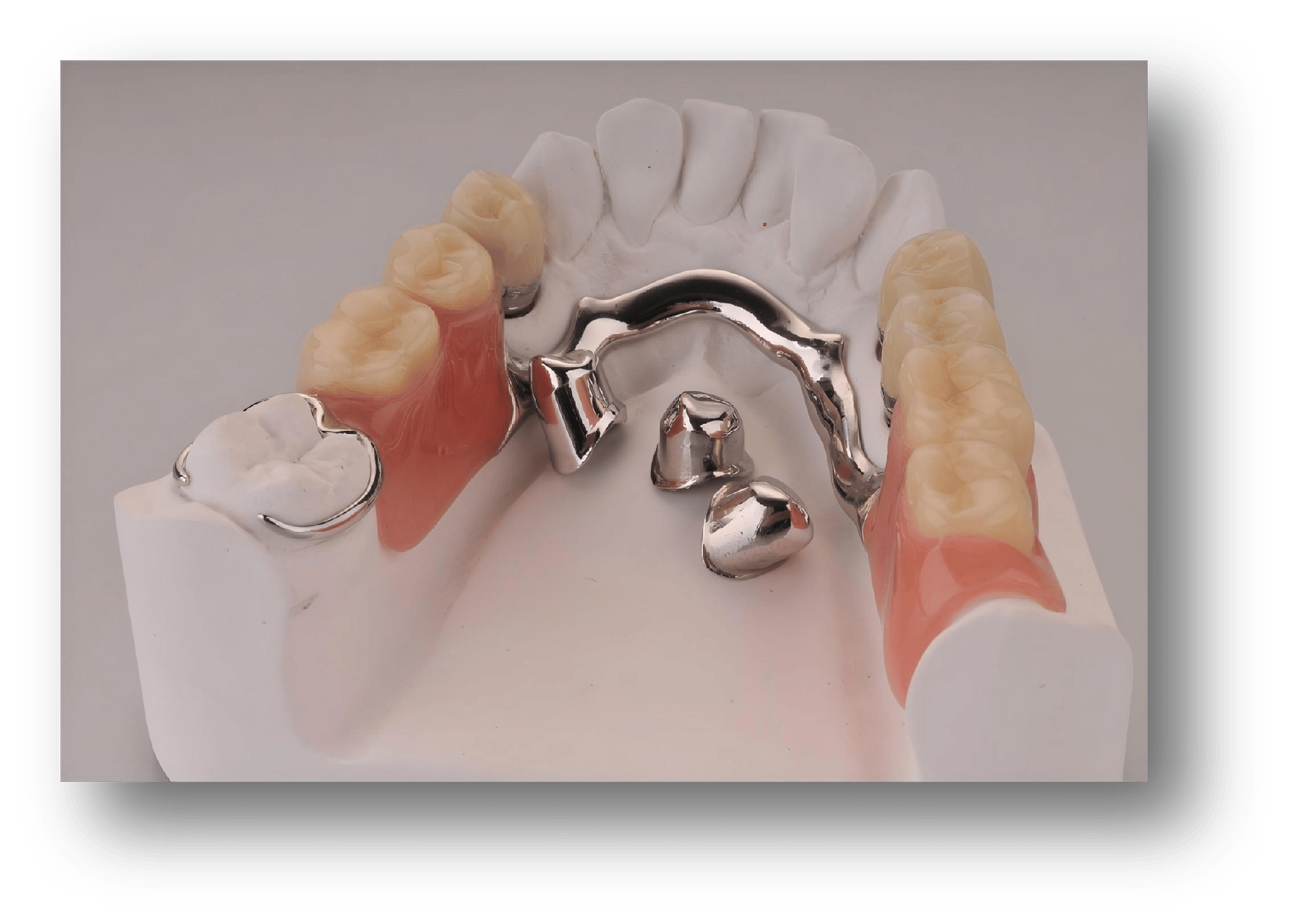 2.Metal Framework Removable Partial Denture (RPD) (2)