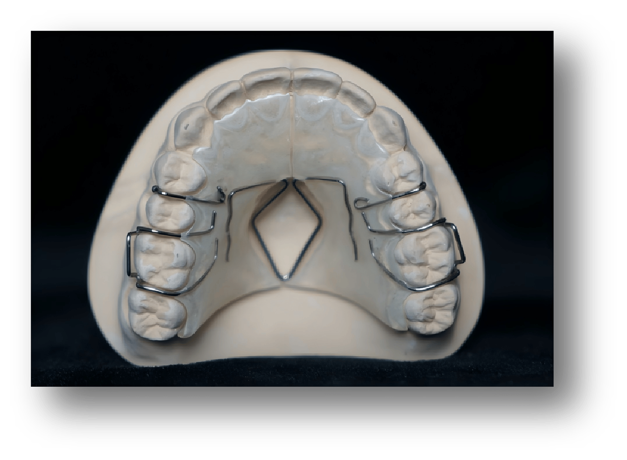 2.Removable Expansion Spring Orthodontic Appliance 2.Removable Expansion Spring Orthodontic Appliance