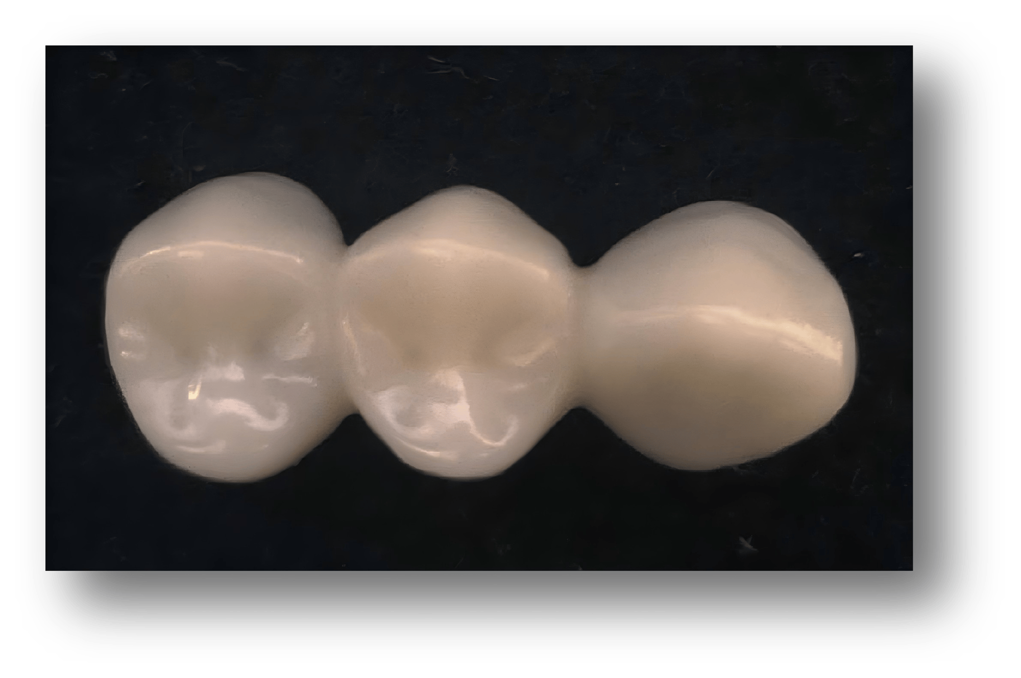 2.Resin-Milled Temporary Crown Bridge