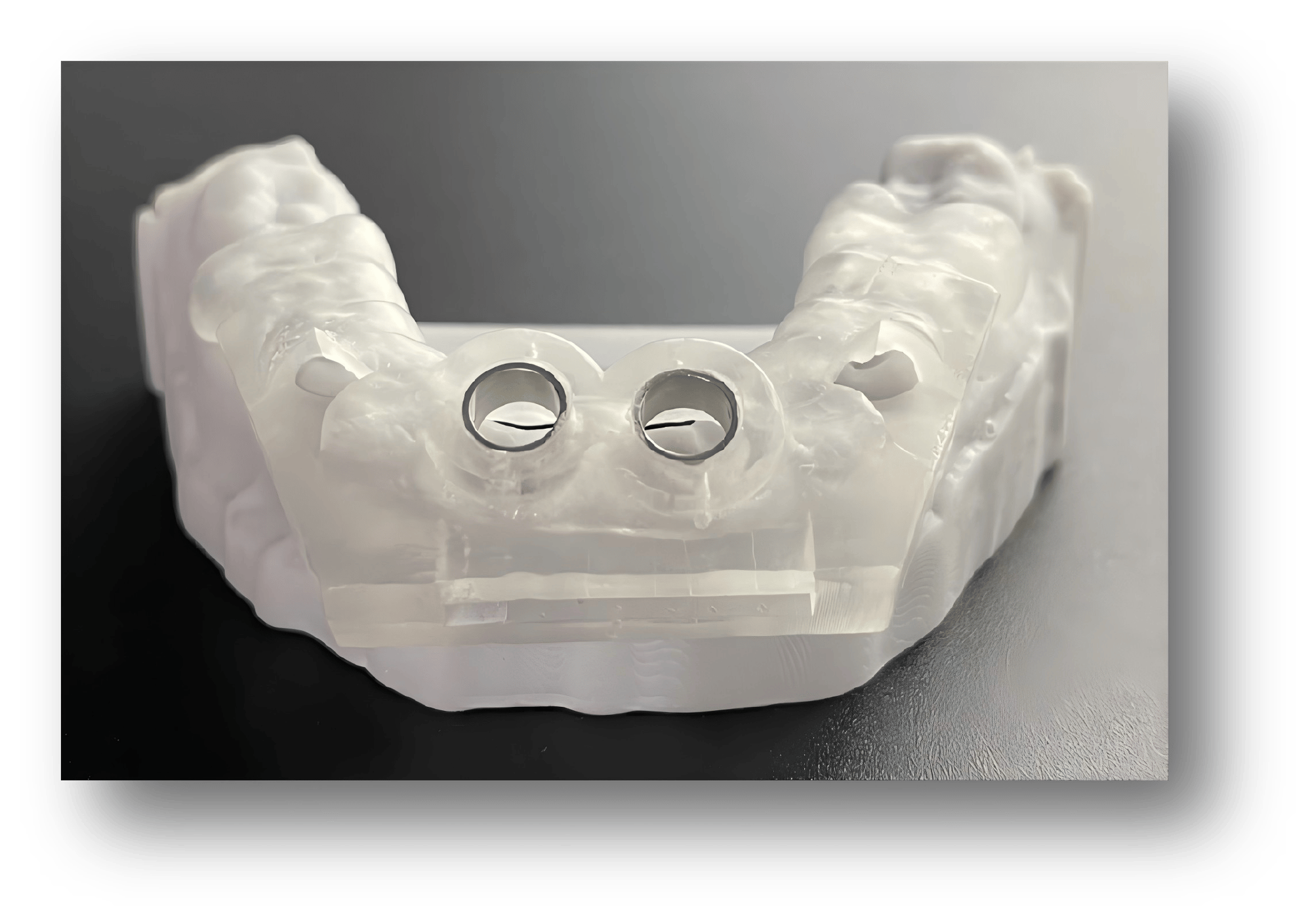 3.3D-Printed Osteotomy & Implant Surgical Guide