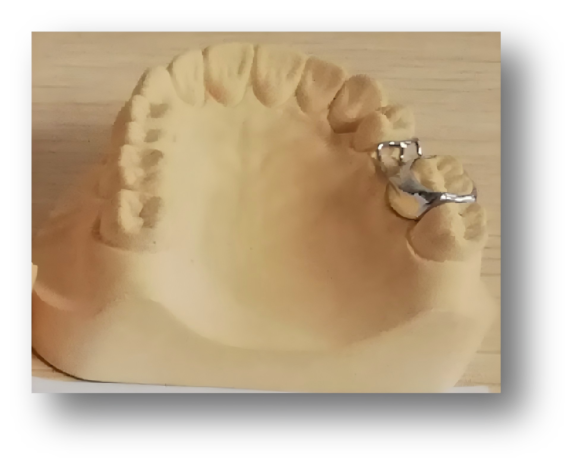 3.Fixed Eruption-Preventing Orthodontic Appliance 3.Fixed Eruption-Preventing Orthodontic Appliance