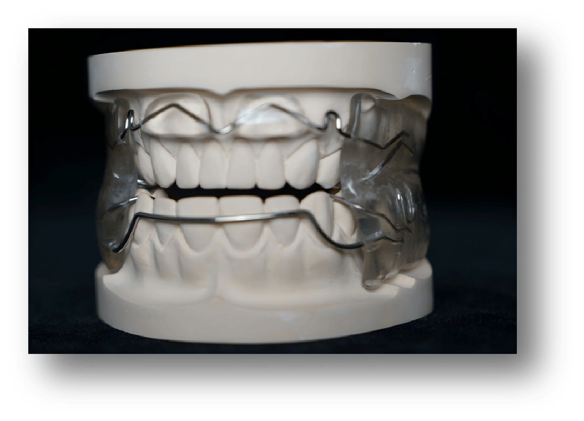 3.Removable Frankel Orthodontic Appliance 3.Removable Frankel Orthodontic Appliance