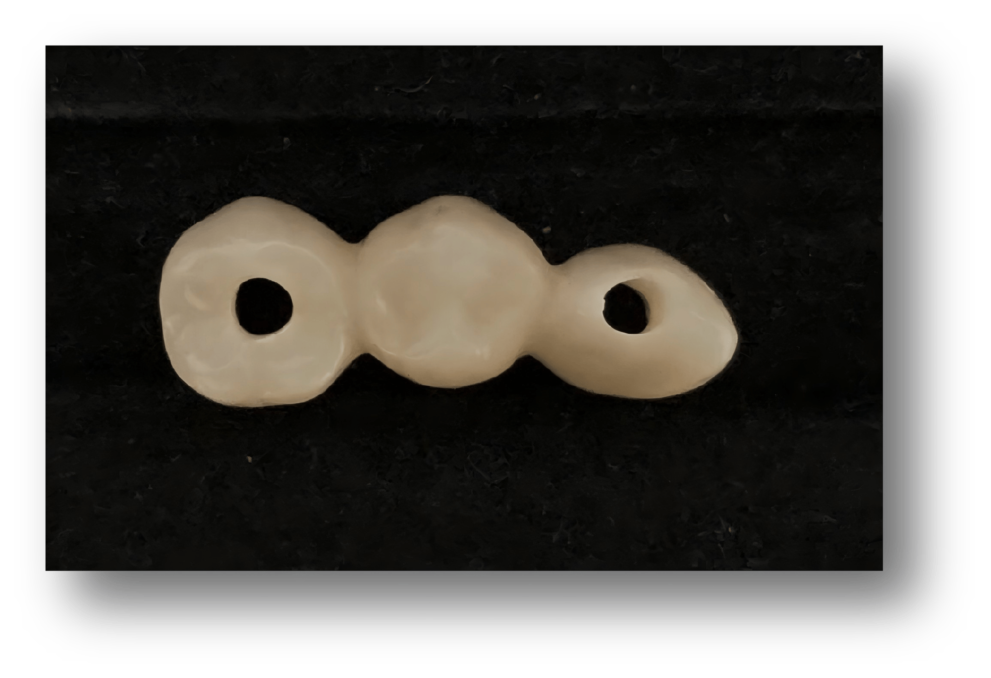 3.Resin-Milled Implant-Supported Temporary Crown Bridge