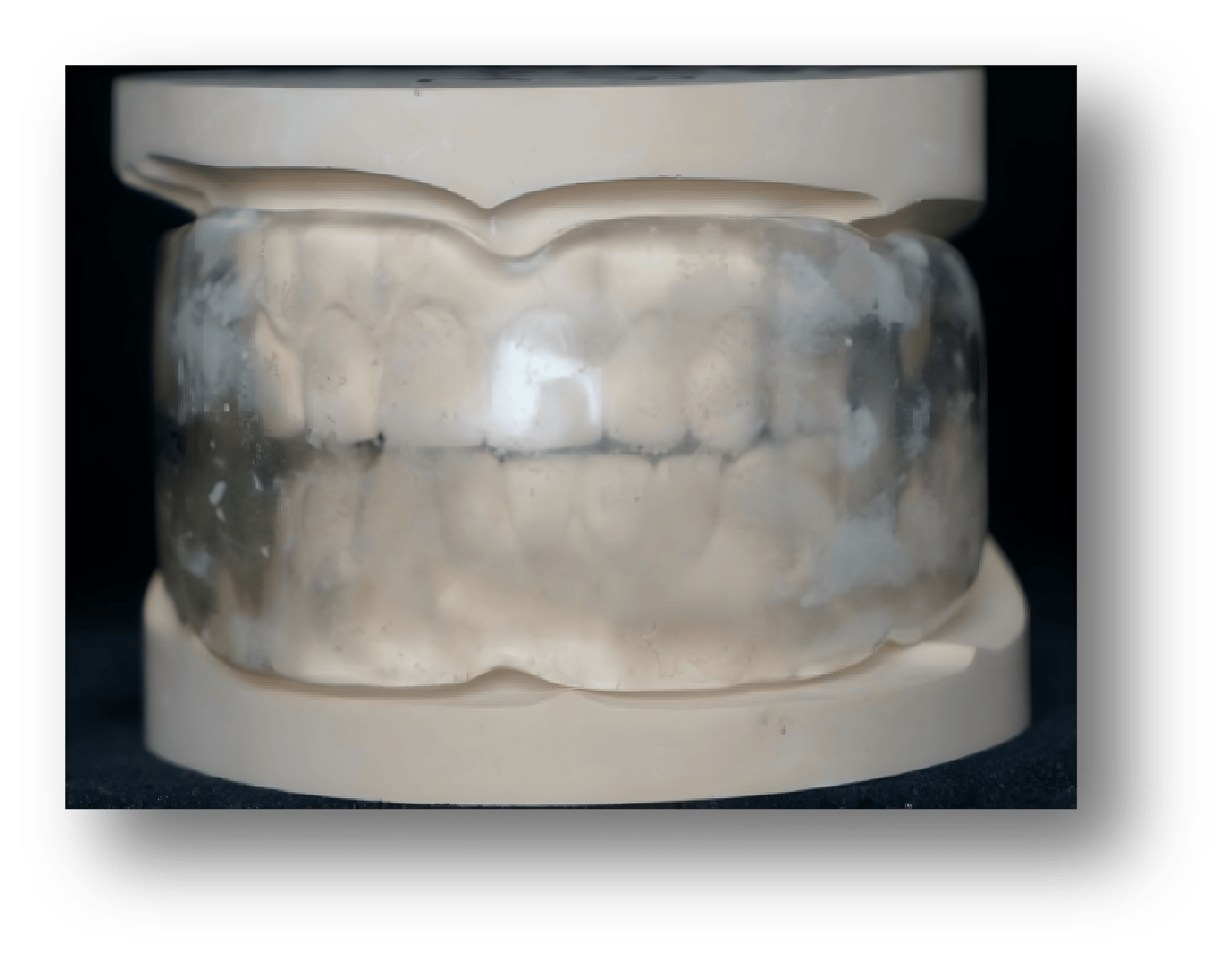 4.Removable Vestibular Shield Appliance 4.Removable Vestibular Shield Appliance