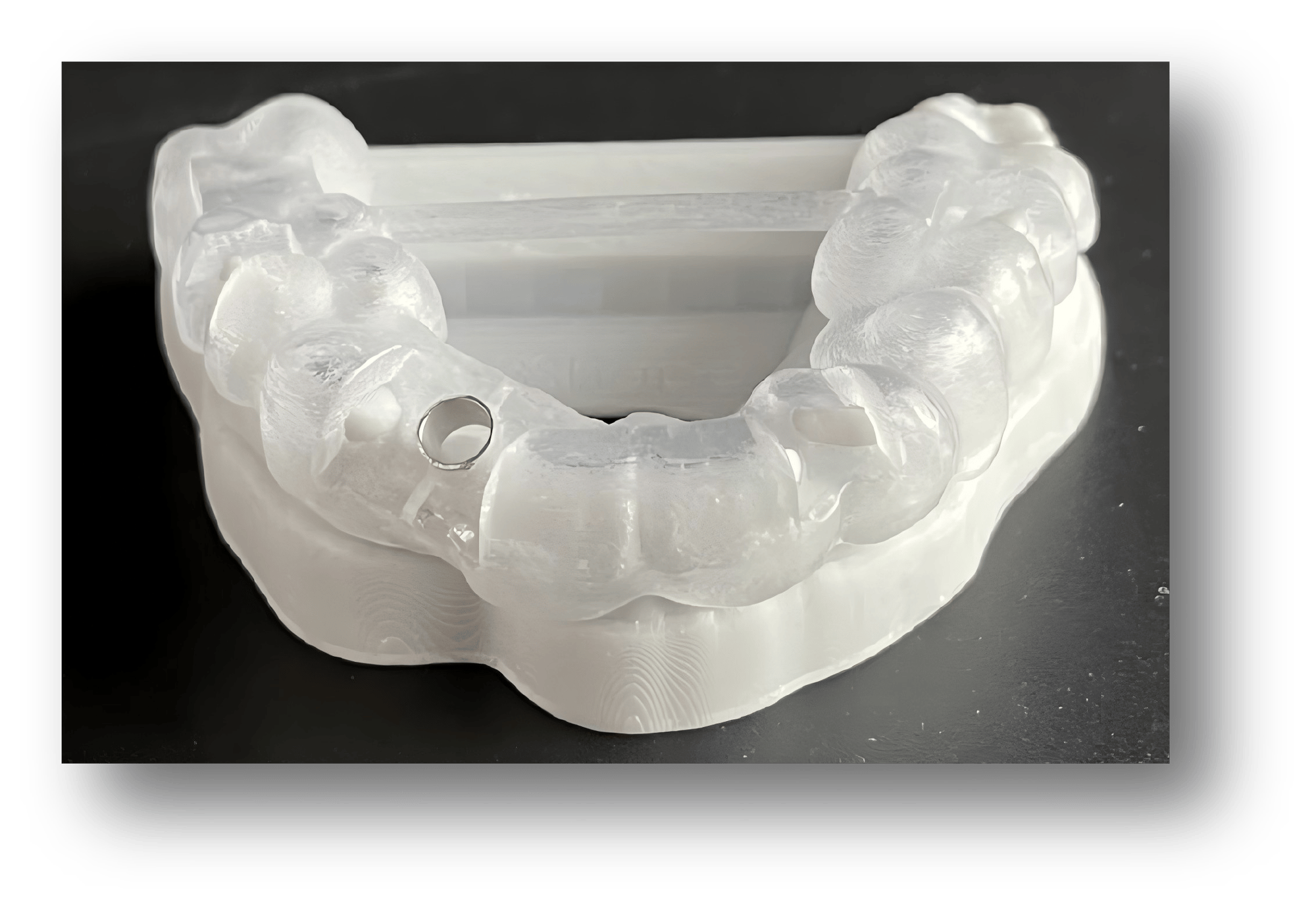 5.3D-Printed Tooth-Supported Implant Surgical Guide