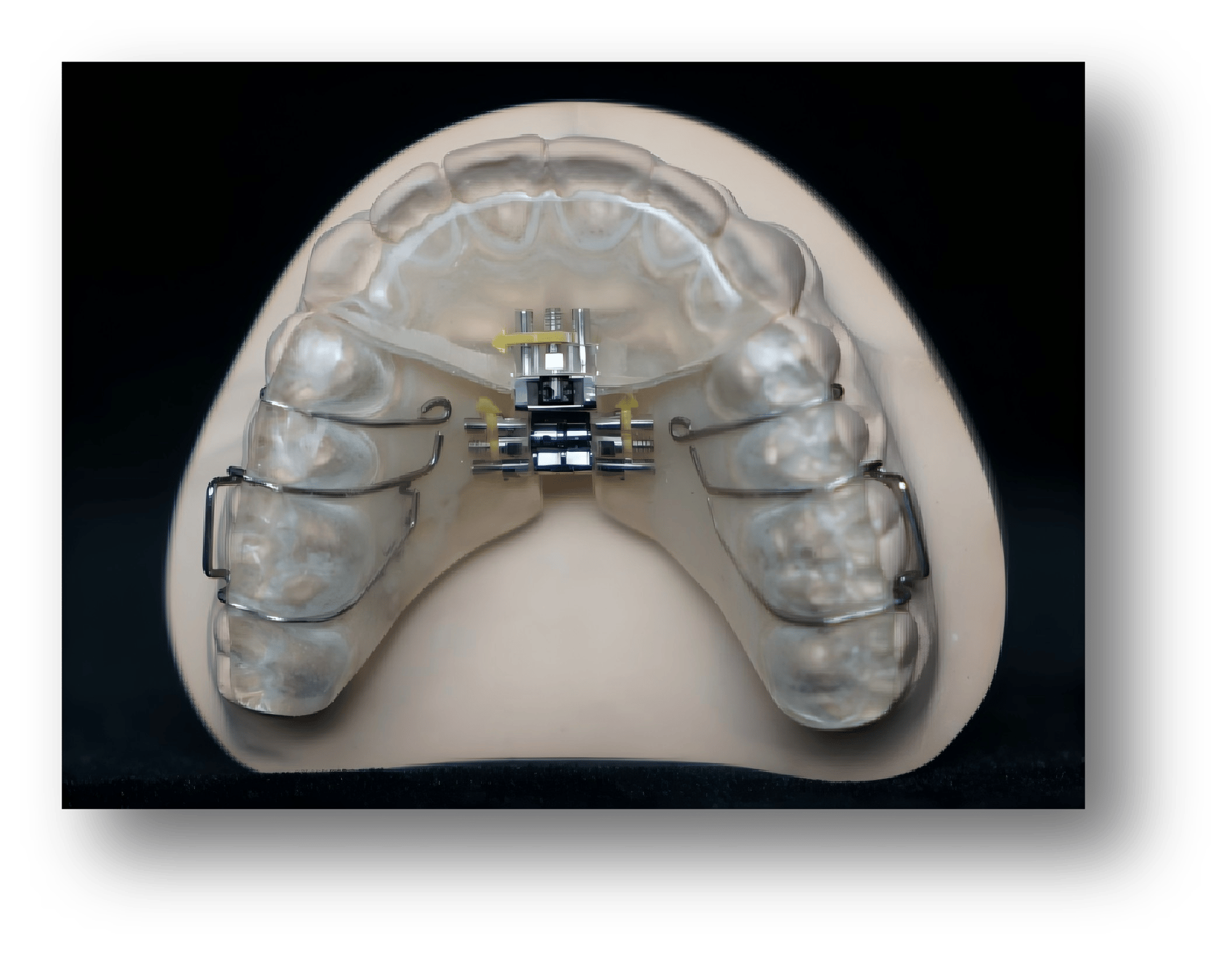 5.Removable Three-Directional Screw Orthodontic Appliance 5.Removable Three-Directional Screw Orthodontic Appliance