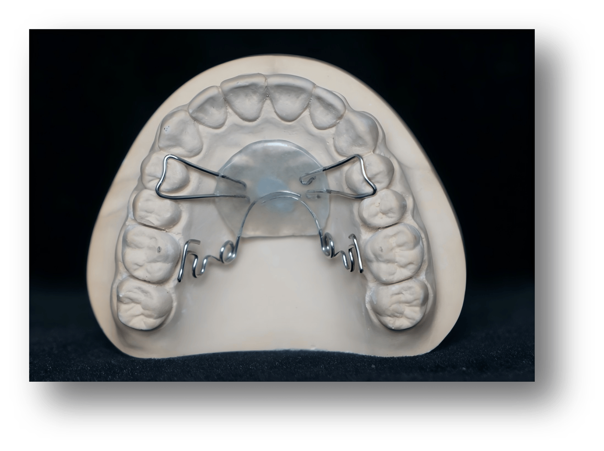 6.Fixed Pendulum Orthodontic Appliance 6.Fixed Pendulum Orthodontic Appliance