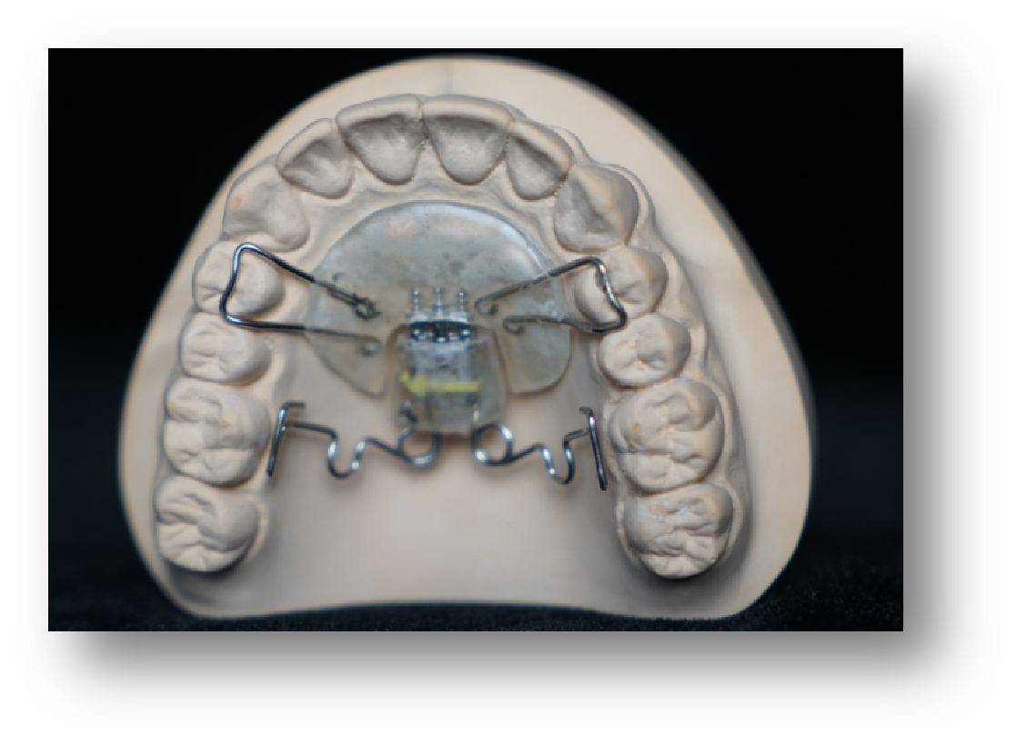 4.Fixed Helical Molar Distalizer Orthodontic Appliance 4.Fixed Helical Molar Distalizer Orthodontic Appliance