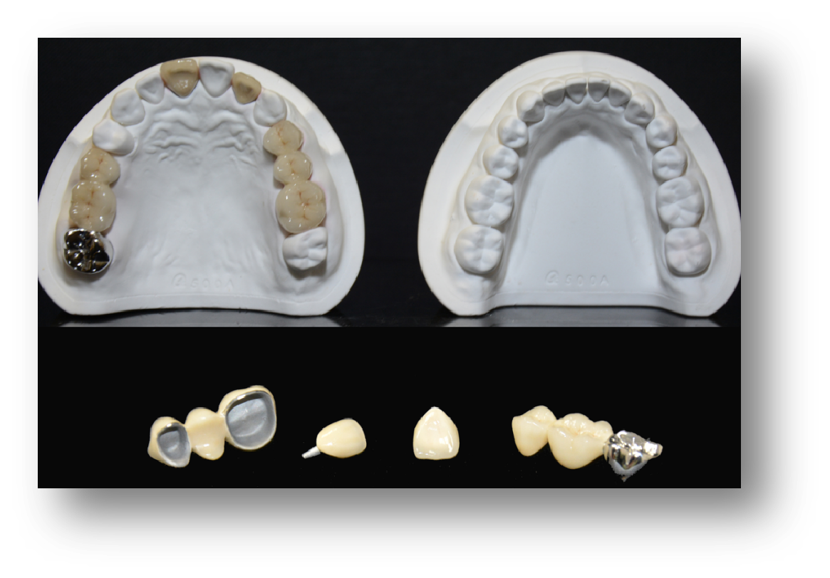 4.Non-Precious Metal Porcelain-Fused-to-Metal (PFM)-1