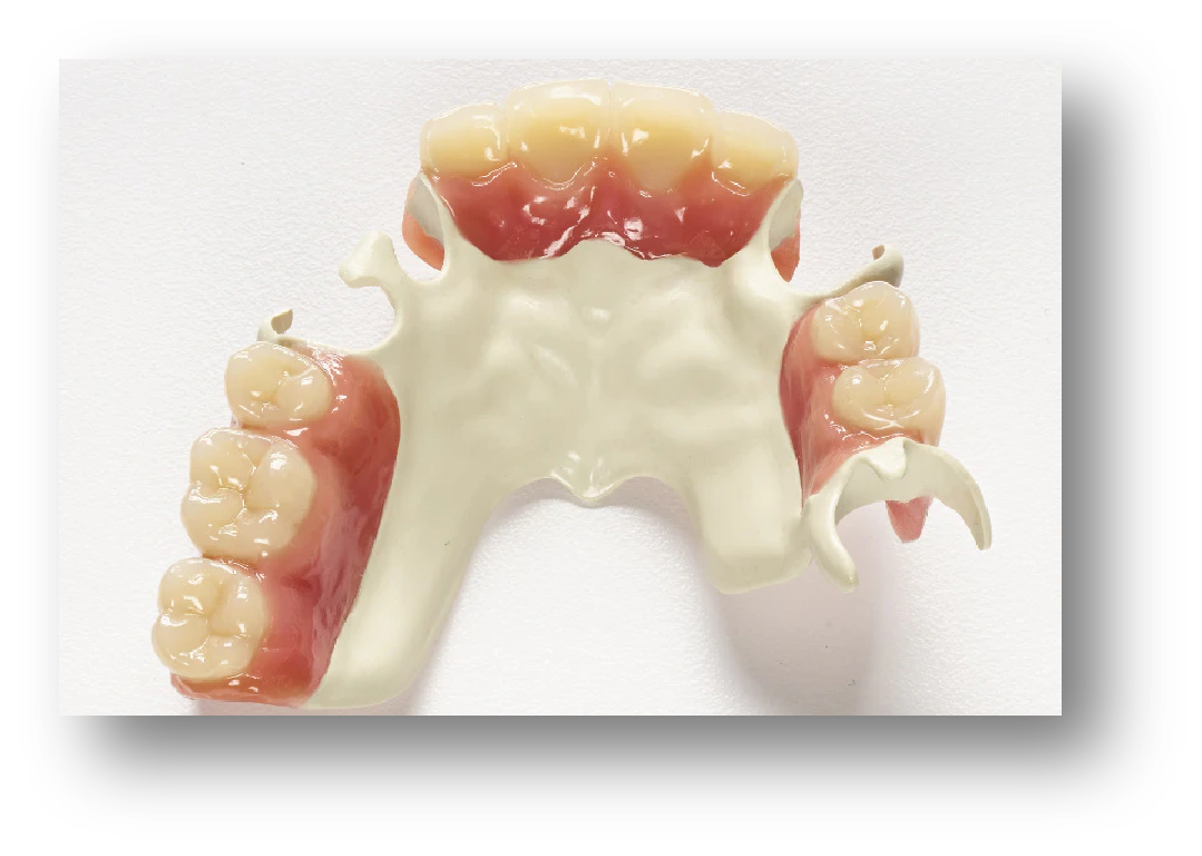 4.PEEK Removable Partial Denture (RPD)