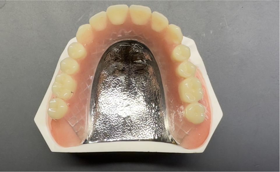 5.Metal Framework Removable Complete Denture (RCD)