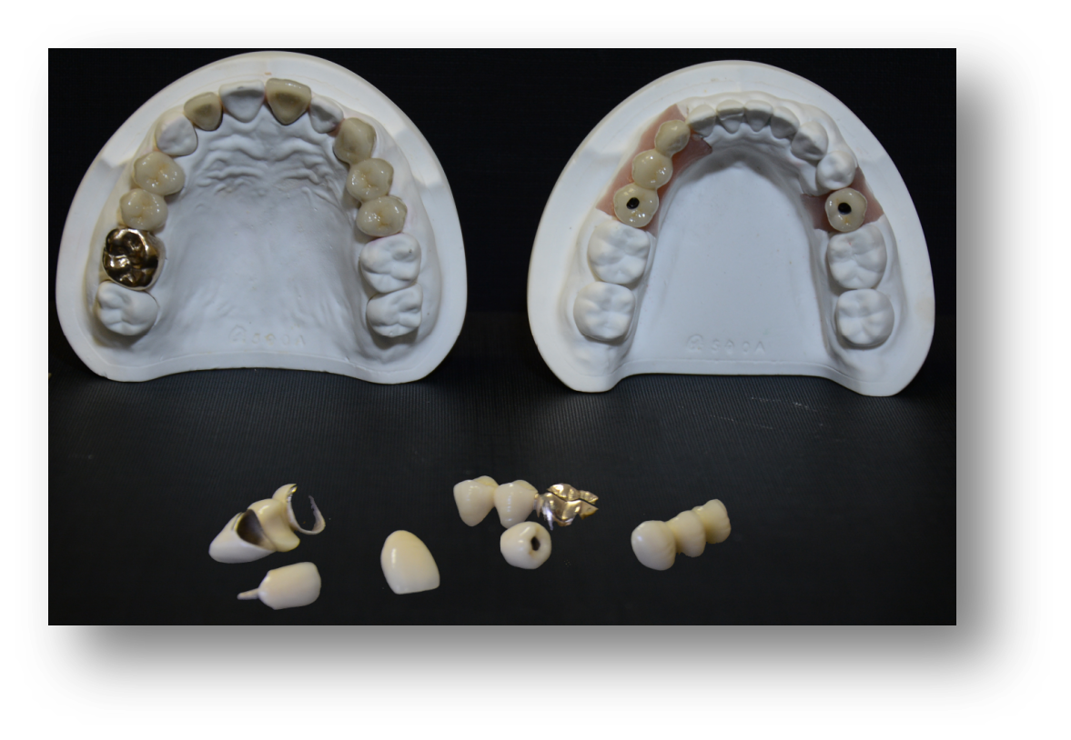 5.Precious Metal Porcelain-Fused-to-Metal (PFM)-1