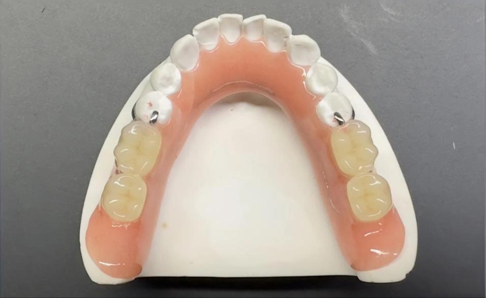 6.Wrought Wire Framework Removable Complete Denture (RCD)